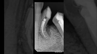 ReRct of 34 and 35 rct premolar shortvideo endodontics [upl. by Ayres653]