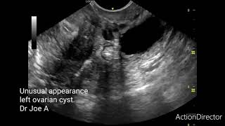 Unusual outpouching ovarian cyst TVS ultrasound video [upl. by Ynnoj531]