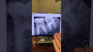 The Nanopix by eighteeth worth buying dentist dentaltreatment xray rvg nanopix [upl. by Edwine]