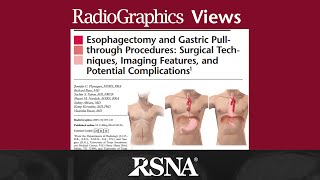 Esophagectomy and Gastric Pullthrough Procedures [upl. by Collie]