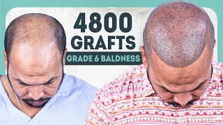 Hair Transplant for Severe Baldness 4800 Grafts 😉  New Roots  Bangladesh [upl. by Acirrej]