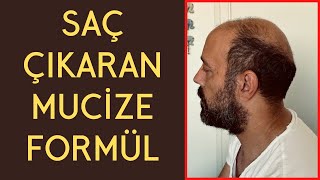 Saçlarım Yeniden Çıktı  Saç Çıkaran MUCİZE FORMÜL  Saç Dökülmesine Kesin Çözüm [upl. by Buller102]