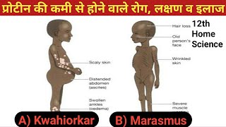 प्रोटीन की कमी से होने वाले रोग लक्षण व इलाज  Kwashiorkor disease  Marasmus disease [upl. by Mahmud]