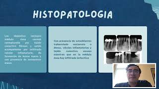 Osteitis Condensante [upl. by Iolande]