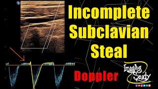 Incomplete Subclavian Steal  Ultrasound  Doppler  Case 241 [upl. by Ivor]