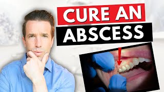 Dentist Explains a Tooth Abscess  How to Cure an Abscess Tooth [upl. by Jeana291]