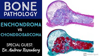 Chondrosarcoma vs Enchondroma Bone Pathology with Dr Andrew Rosenberg [upl. by Nautna106]