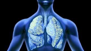 Effects of Asbestos on the Lungs [upl. by Allemac104]