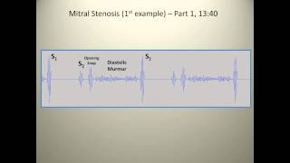 Examples of mitral stenosis murmurs [upl. by Adnahcir]