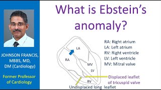 What is Ebstein’s anomaly [upl. by Javed489]