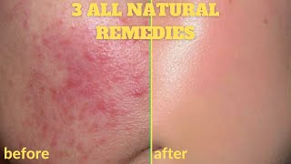 HOW TO GET RID OF ACNE  SCARS OVERNIGHT  3 DIY HOME REMEDIES  ALL NATURAL FACE MASKS 100 Works [upl. by Aivatra]