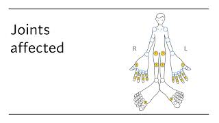 Its Not Just Arthritis A Lecture Overview on Arthritis Diagnosis and Management [upl. by Symons287]