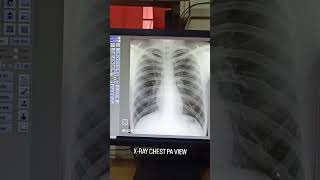 CHEST XRAY PA VIEW PRINT LAYOUT xray xraytechnician xrays radiology [upl. by Senecal]