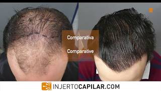 6202 Grafts HT by FUE Technique Advanced alopecia Injertocapilarcom18082016 [upl. by Lindner]