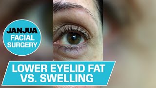 LOWER EYELID FAT VS SWELLING  DR TANVEER JANJUA  NEW JERSEY [upl. by Nuahsor731]