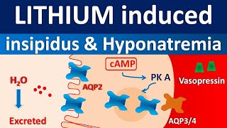 Lithium induced diabetes insipidus and hyponatremia [upl. by Assi]