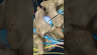 Lumbar Epidural Steroid Injection 3D Animation [upl. by Rome582]