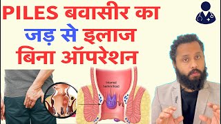 Permanent Treatment of Piles  haemorrhoids treatment Dr Prateek chauha [upl. by Repsac]