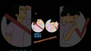 Management of epistaxis nosebleed epistaxis orthopedics mbbs [upl. by Hnao]