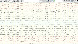 EEG Ictalinterictal continuum [upl. by Sieber118]