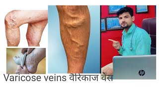 quotHomeopathic medicine and treatment for varicose veins वैरिकाज़ वेंस – explainedquot [upl. by Delanty988]