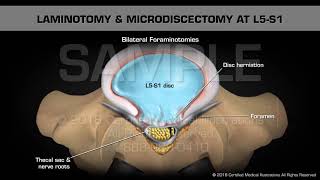 Laminotomy amp Microdiscectomy at L5S1 [upl. by Hannus]