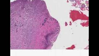 Histopathology Bone vertebraeOsteomyelitis and chondritis [upl. by Vernen]