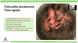 ALOPECIAS CICATRIZALES PRIMARIAS FOLICULITIS DECALVANTE [upl. by Odiug]