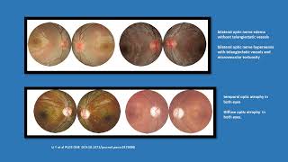 Neurology Quiz 98 Lebers hereditary optic neuropathy LHON [upl. by Ahseei932]