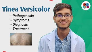 Superficial mycoses  Tinea Versicolor  Malassezia furfur  Microbiology bangla lecture [upl. by Kirby]