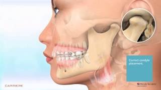 Carriere® Motion™ Appliance for Class II Patient Education Animation 2 [upl. by Shalna]