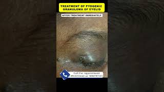 Treatment of pyogenic granuloma  By Dr Uttam Kumar Lenka MBBS MD Consultant Dermatologist [upl. by Aistek353]