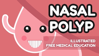 What is Nasal Polyp [upl. by Cirdnek]