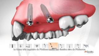 Système de piliers MultiUnit par ALPHABIO TEC [upl. by Anad]