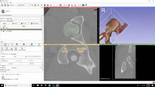 DICOM to STL Conversion Tutorial with Segment Editor [upl. by Noraf]