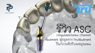 รีวิว ASC Angulated Screw Channel Abutment สุดคูลจาก TruAbutment ไว้แก้เกมส์ปรับAxisรูScrew [upl. by Heidt278]