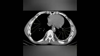 TUBERCULOUS EMPYEMACHRONIC  XRAY AND CT IMAGEA new case every daySame time tomorrow [upl. by Endaira139]