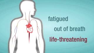 Valve Regurgitation When a Heart Valve Leaks [upl. by Anned]