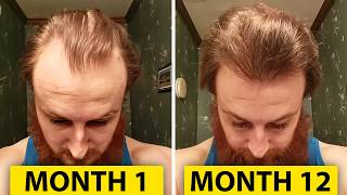 How To Reverse Hair Loss In 12 Months [upl. by Orms]