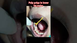 pulp polyp in relation to lower 1st molar see and take best treatment [upl. by Casilda332]