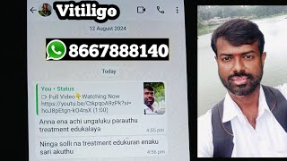 வெண்புள்ளிக்கு சரியான மருத்துவம் எது  vitiligo treatment awareness [upl. by Elleiand]