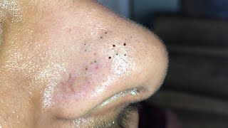 Blackhead SPA reddit skincare popping blackheads pimples medication [upl. by Utter]