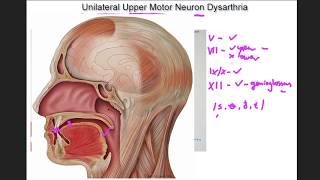 Unilateral Upper Motor Neuron Dysarthria  example and tutorial [upl. by Assirk]