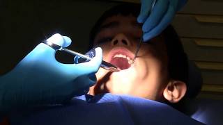 Tooth filling in school dental clinic Part 2 Tooth filling [upl. by Notxam]