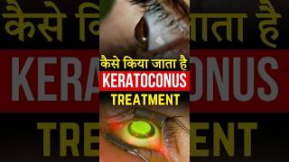 कैसे किया जाता है Keratoconus Treatment [upl. by Queridas]