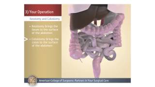 ColostomyIleostomy Your Operation [upl. by Roderica326]