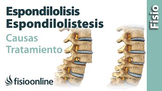 Espondilolisis y espondilolistesis  Qué es causas síntomas y tratamiento [upl. by Mcloughlin497]