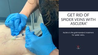 The Gold Standard Spider Vein Treatment [upl. by Nerdna710]