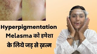 Magical Remedy for Hyperpigmentation Melasma  Pigmentation treatment at Home  Dr Upasana Vohra [upl. by Rufina]