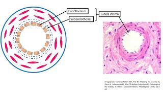 Hyaline arteriolosclerosis [upl. by Aube]